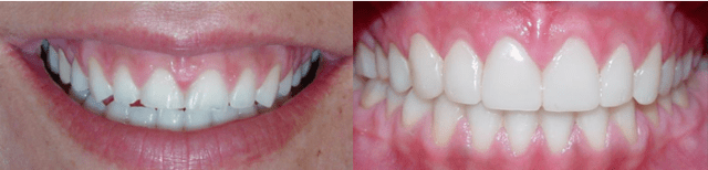 Gengivoplastia-antes-e-depois3