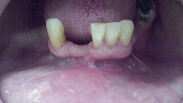 Foto do rebordo inferior já reparado da cirurgia de frenectomia. Removemos o freio labial inferior.